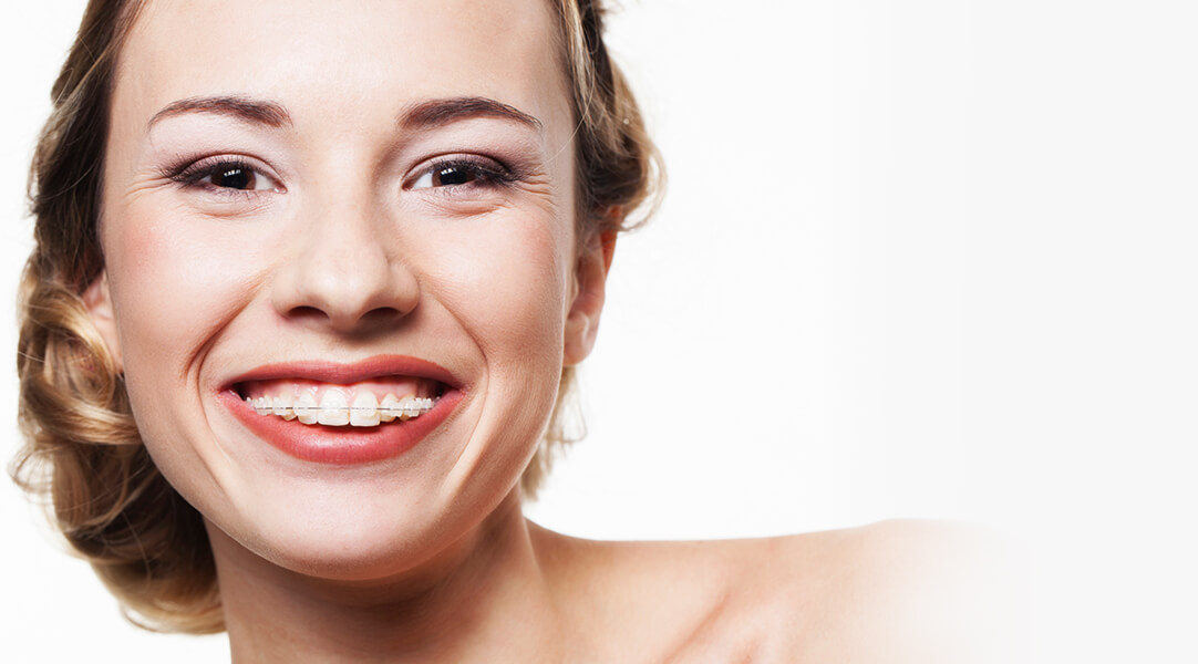 ClearBraces3